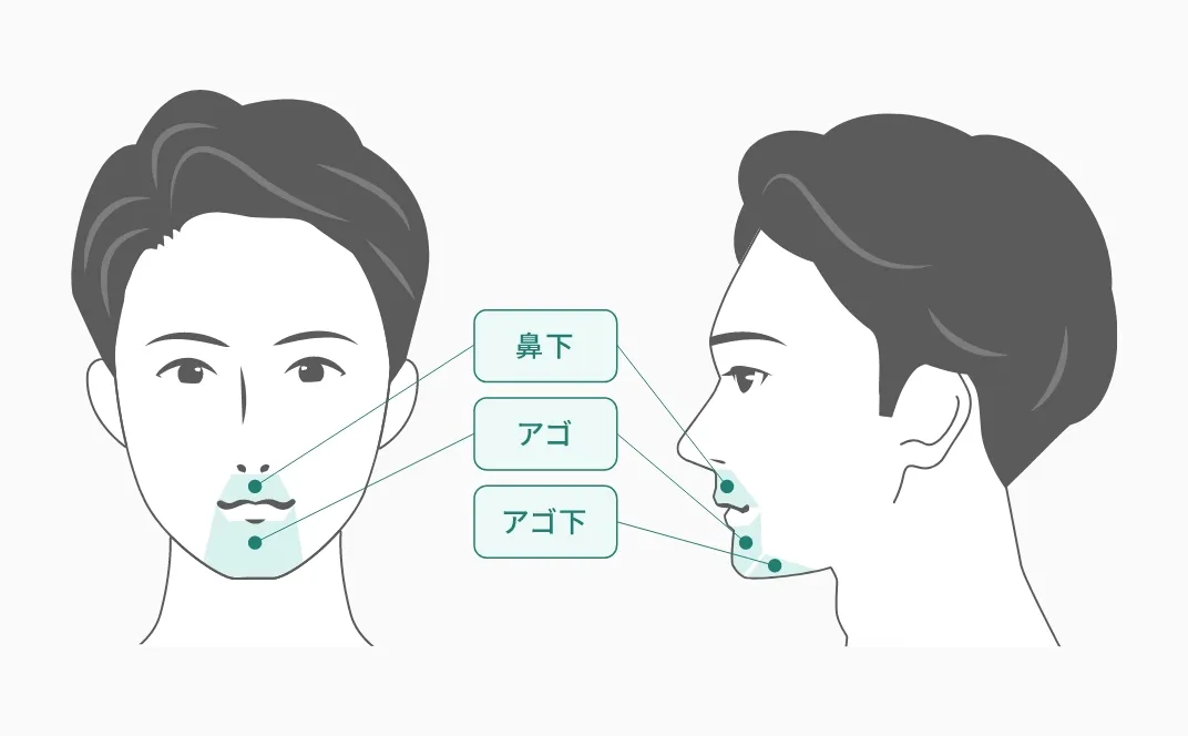 ヒゲ脱毛(3部位)